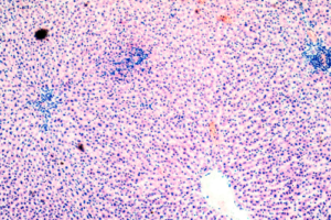 Diferencia entre la fibrosis hepática y la cirrosis