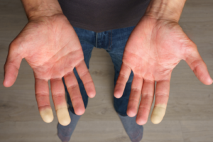 Diferencia entre el síndrome de Raynaud y la enfermedad