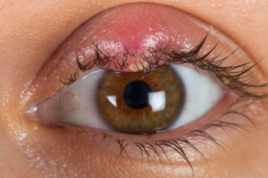 Diferencia entre Hordeolum y Chalazion