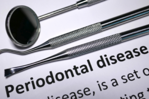 Diferencia entre pericoronitis y periodontitis