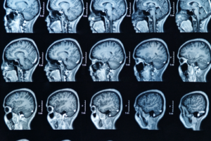 Diferencia entre secreción nasal y líquido cerebral
