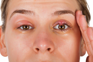 Diferencia entre Hordeolum y Chalazion y Blefaritis