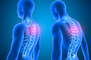 Diferencia entre sacroiliitis y ciática