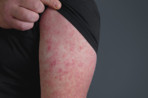 Diferencia entre celulitis y erisipela